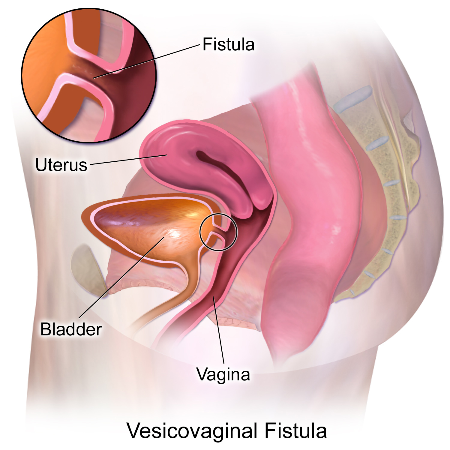 fistula meaning in hindi?