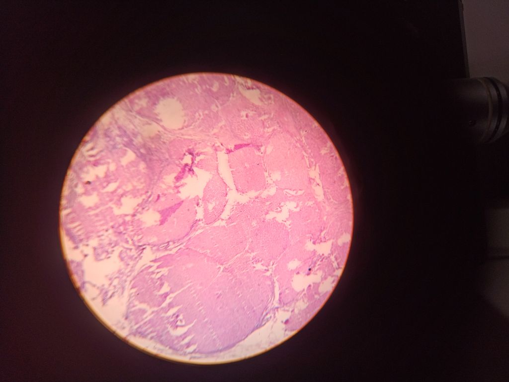 Ayurvedic Treatment for Liver Cirrhosis