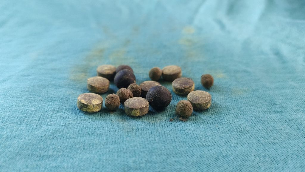 Finding the Best Ayurvedic Medicine for Gallbladder Stone