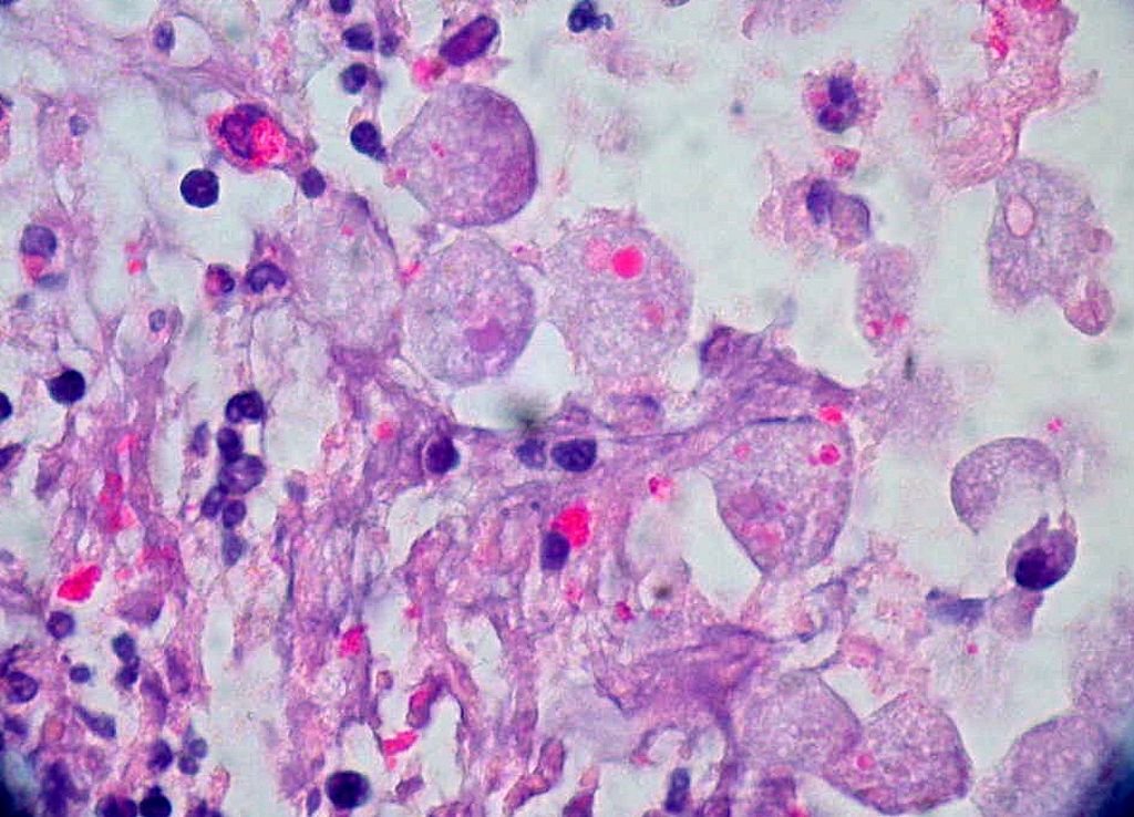 Amoebica Tablet: Fighting Amoebic Infections